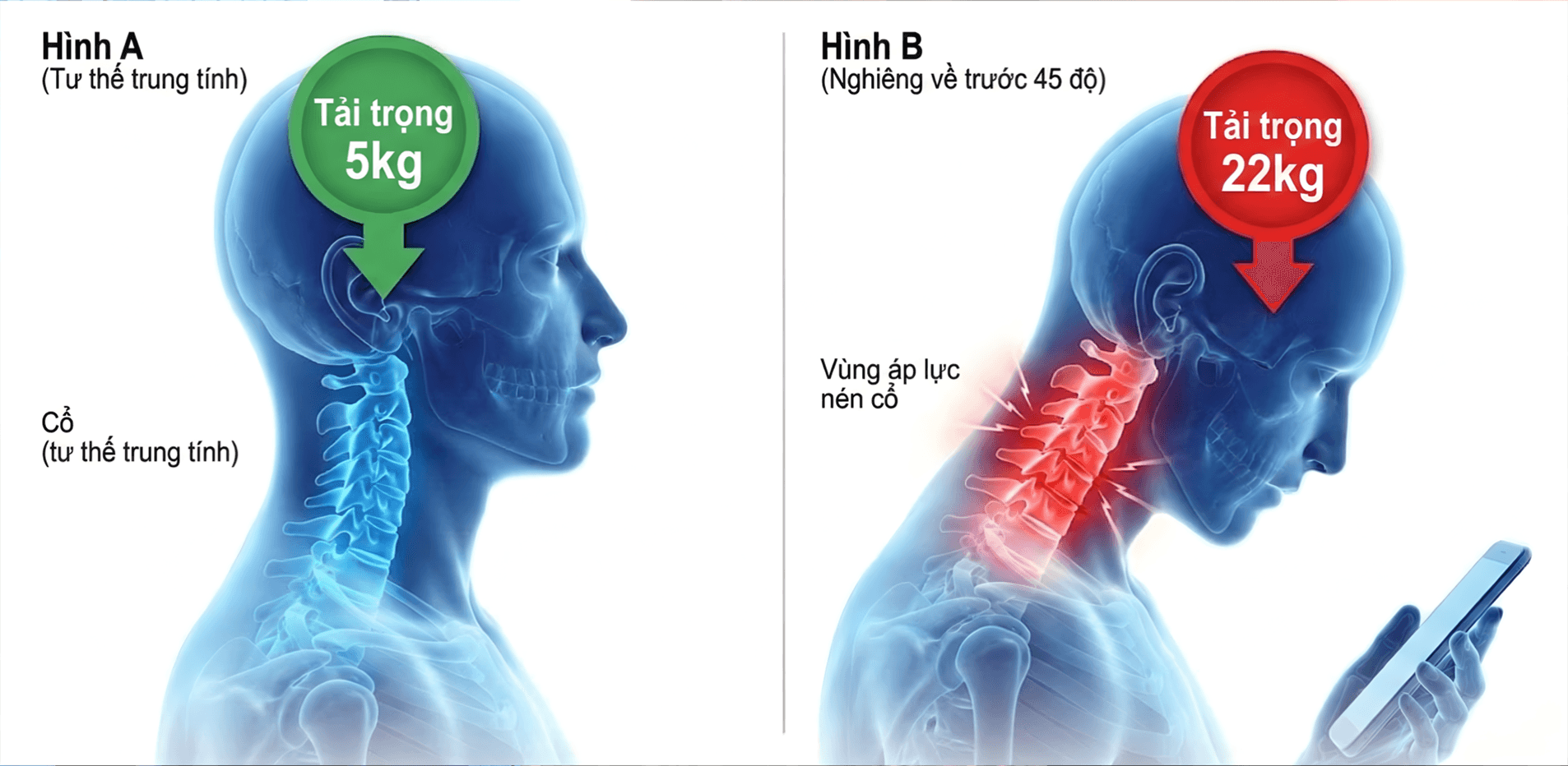 Hình ảnh: Hình ảnh so sánh góc độ nghiêng của đầu. Một bên là tư thế thẳng, một bên là tư thế cúi xem điện thoại, với hình ảnh mô phỏng trọng lượng (quả tạ hoặc số kg) đè lên đốt sống cổ.